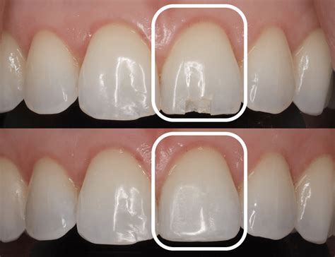 Ozark Chipped Tooth Repair 